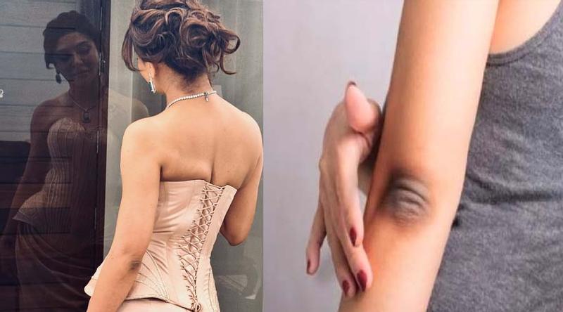 হাঁটু-কনুইয়ের কালো দাগ দূর করবেন কীভাবে?