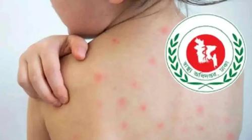 হামের উপসর্গে আরও পাঁচ শিশুর মৃত্যু