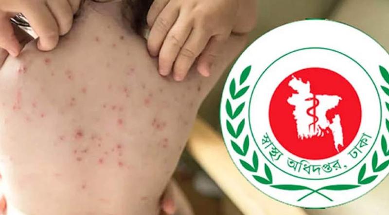 হামের উপসর্গ নিয়ে আরও ৪ শিশুর মৃত্যু